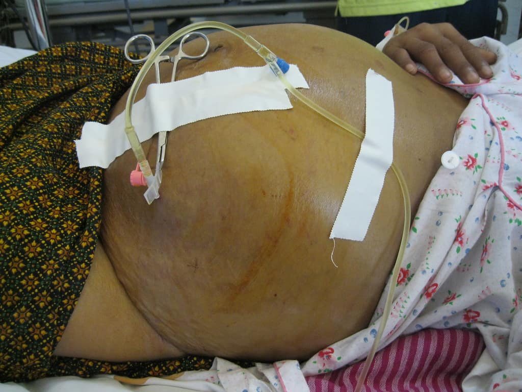 Ascites: एसाइटिस क्या है ?