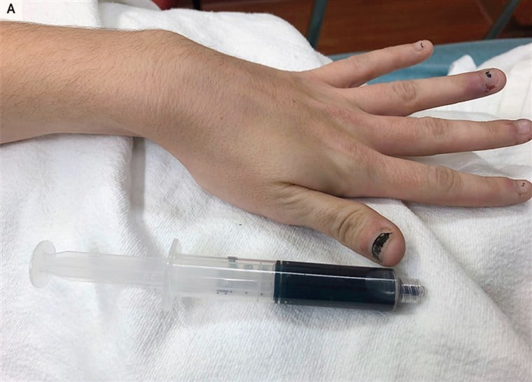 दांत दर्द की दवा खाने के बाद महिला का खून हुआ नीला, जानिए क्या है एनेस्थीसिया