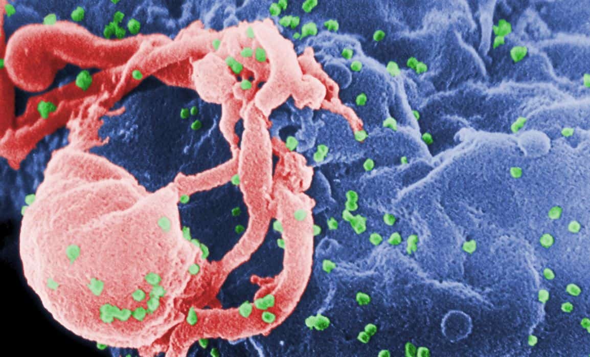 एड्स पीड़ित व्यक्ति की स्थिति बता सकता है CD 4 टेस्ट