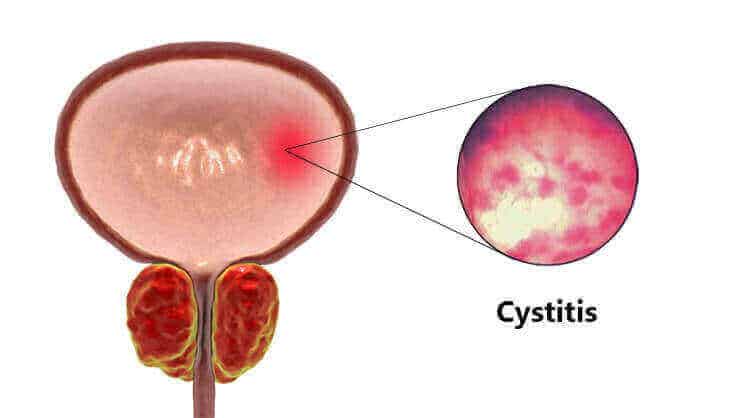 Cystitis: सिस्टाइटिस क्या है? जानें इसके कारण, लक्षण और उपाय