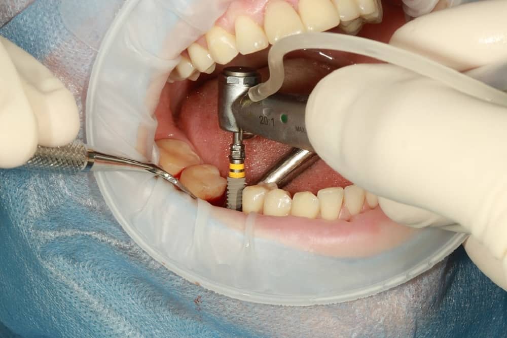 Dental Implant : डेंटल इम्प्लांट क्या है?