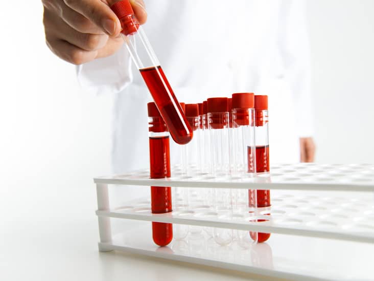 Dexamethasone Suppression Test: डेक्सामेथासोन सप्प्रेशन टेस्ट क्या है?