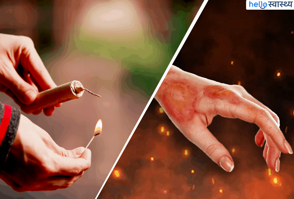 पटाखों से जल जाएं, तो अपनाएं ये टिप्स
