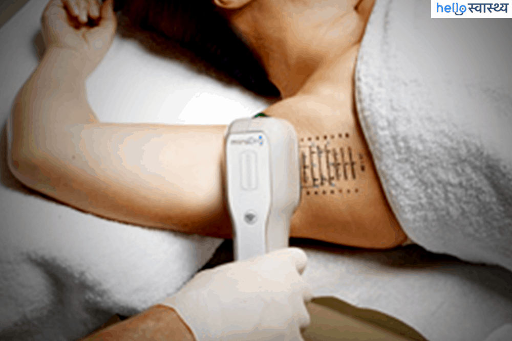 अंडर आर्म के पसीने और बदबू से छुटकारा दिलाएगा मीराड्राई ट्रीटमेंट