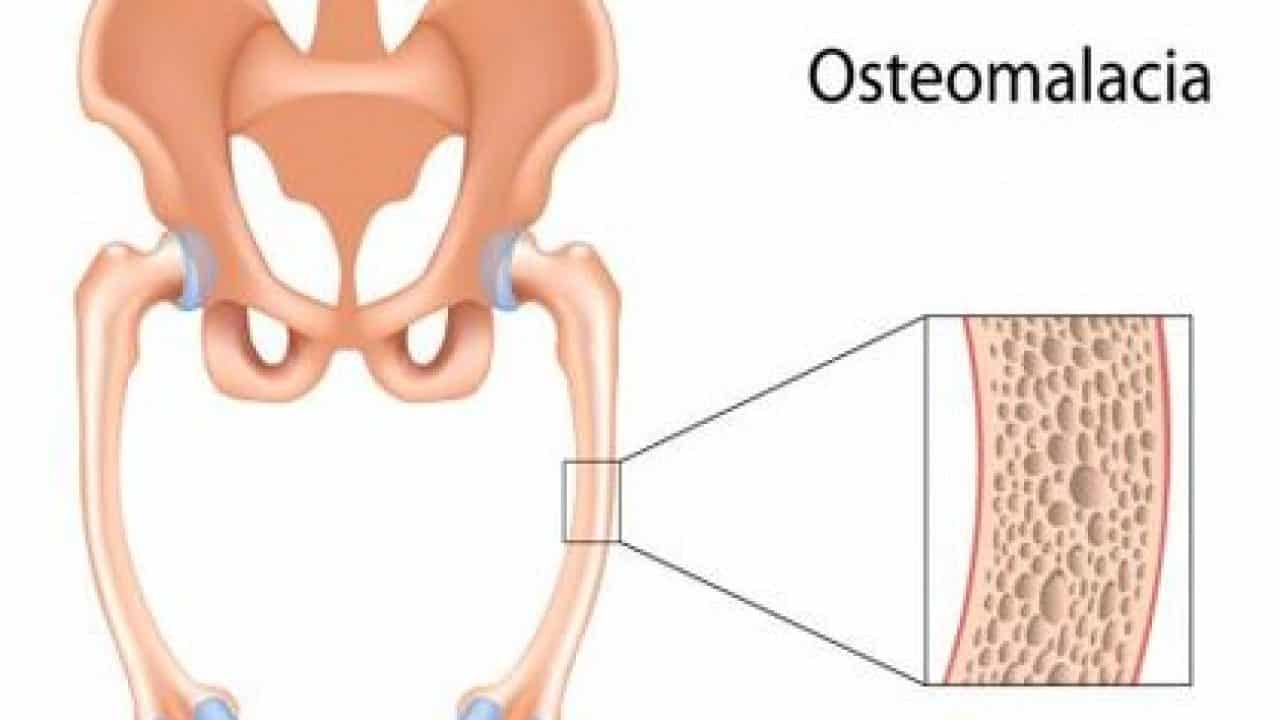 Osteomalacia : ओस्टियोमलेशिया क्या है ?