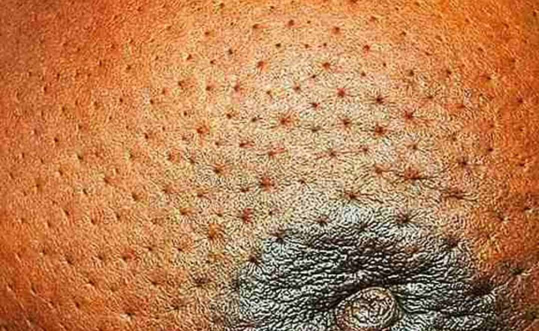 'पॉ द'ऑरेंज' (Peau D'Orange) कहीं कैंसर तो नहीं!