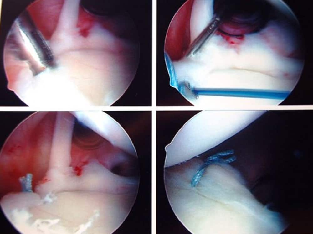 Shoulder Surgery : शोल्डर (कंधे) सर्जरी क्या है?