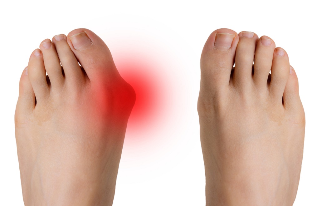 Bunion Surgery : बनियन सर्जरी क्या है?
