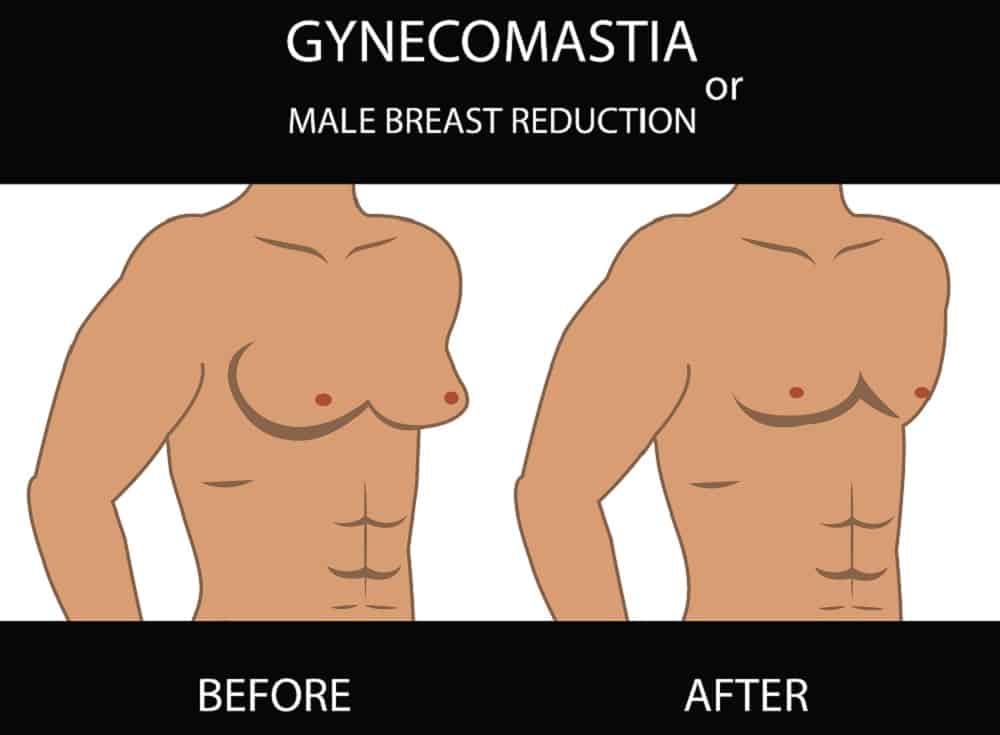 Male Breast Reduction : मेल ब्रेस्ट रिडक्शन कैसे होता है?