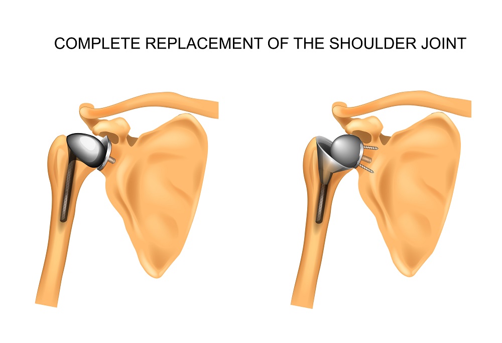 Shoulder Replacement Surgery : शोल्डर रिप्लेसमेंट सर्जरी क्या है?