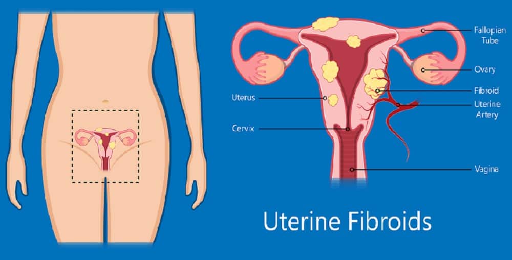 Myomectomy: मायोमेक्टमी क्या है?
