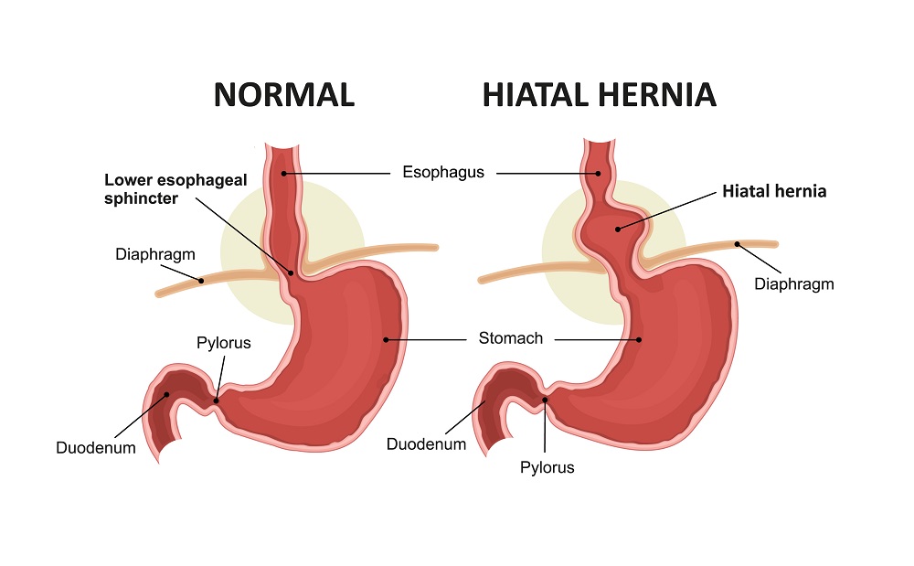 Hiatal Hernia Surgery : हाइटल हर्निया सर्जरी क्या है?