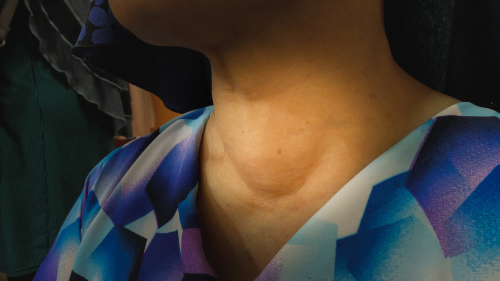 आयोडीन की कमी से हो सकती हैं कई स्वास्थ्य समस्याएं!