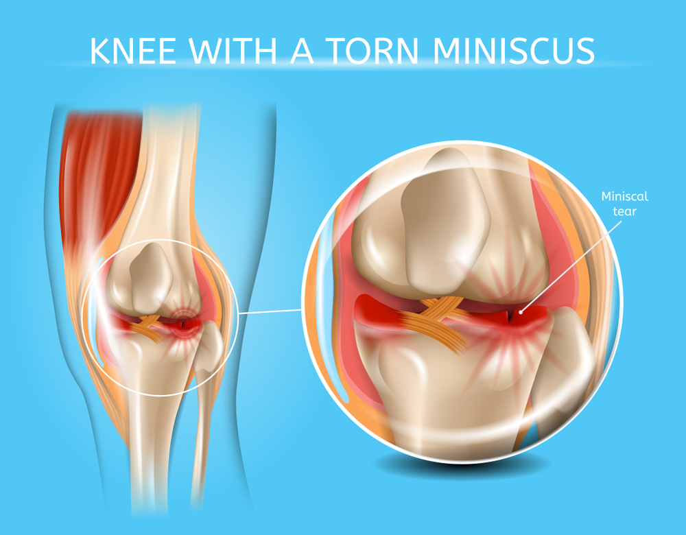 Meniscus Surgery: मेनिस्कस सर्जरी क्या है?