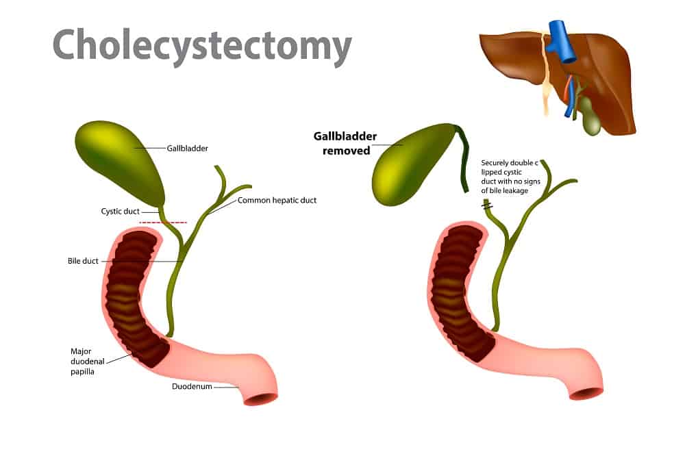 Laparoscopic Cholecystectomy : लैप्रोस्कोपिक कॉलेसिस्टेक्टमी क्या है?