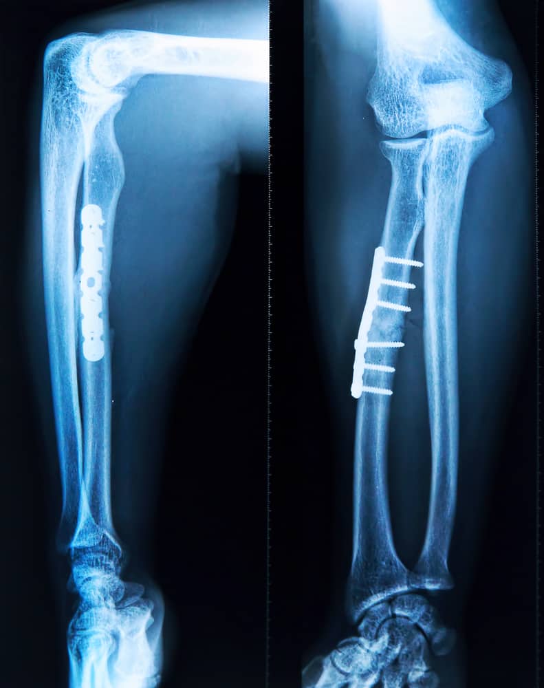 बोन ग्राफ्टिंग क्या है और क्यों किया जाता है, जानिए इसकी प्रक्रिया