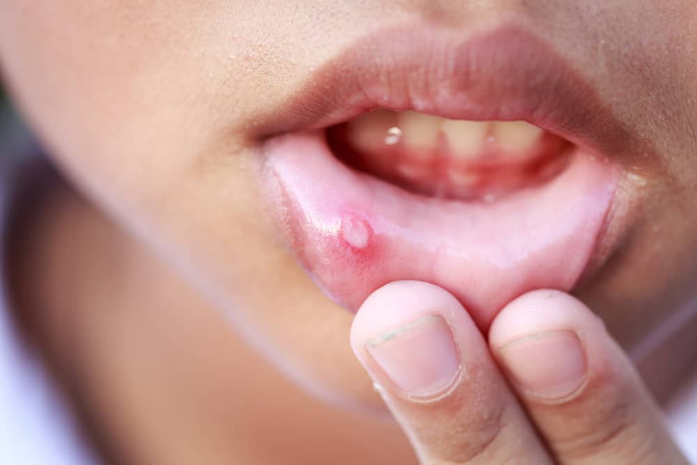जानिए मुंह में छाले (Mouth Ulcer) होने पर क्या खाएं और क्या न खाएं
