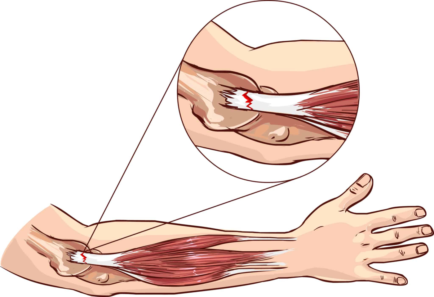 Tennis Elbow: टेनिस एल्बो क्या है?
