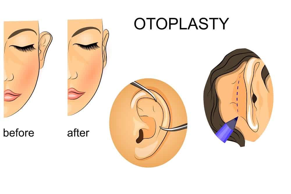 Otoplasty : ओटोप्लास्टी क्या है?