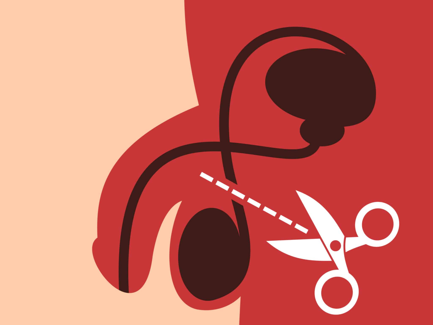 Vasectomy : पुरुष नसबंदी क्या है‌ ?