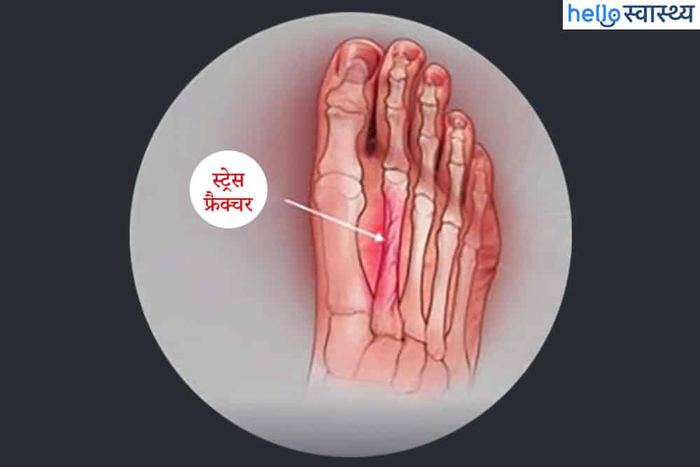 Stress fracture : स्ट्रेस फ्रैक्चर क्या है?