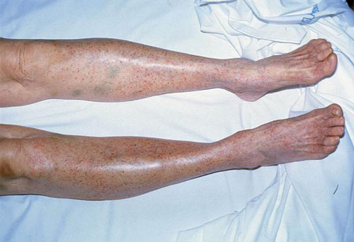 Thrombocytopenia: थ्रोम्बोसाइटोपेनिया क्या है? जानें इसके कारण, लक्षण और उपाय