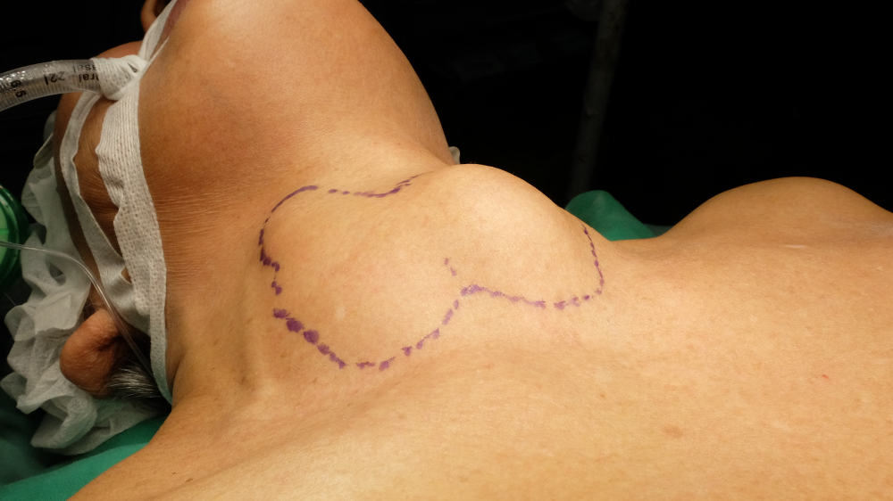 Thyroidectomy : थायराइडेक्टॉमी क्या है?