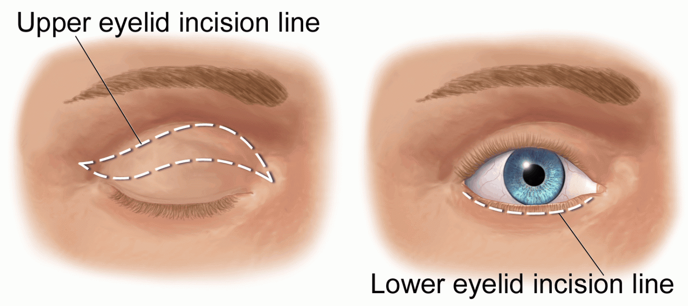 Blepharoplasty: ब्लेफरोप्लास्टी क्या है?