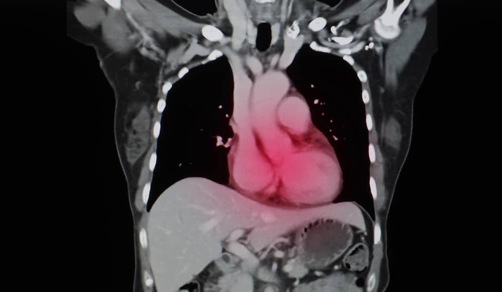 Coronary Angiogram: कोरोनरी एं‍जियोग्राफी (एंजियोग्राम) क्या है?