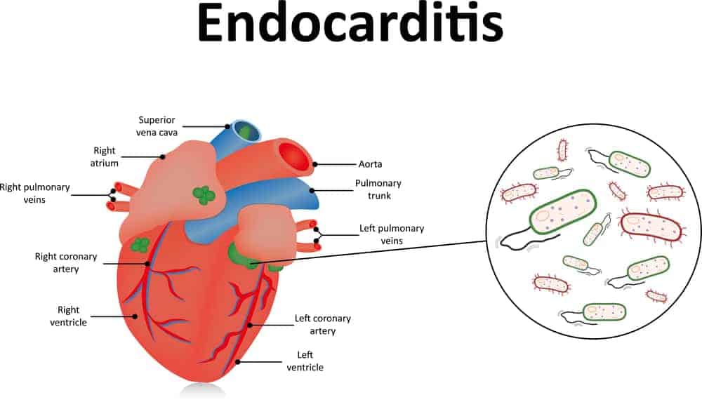 Endocarditis : एंडोकार्डाइटिस क्या है?
