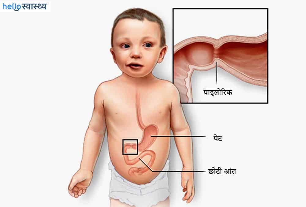 Pyloric Stenosis : पाइलोरिक स्टेनोसिस क्या है?