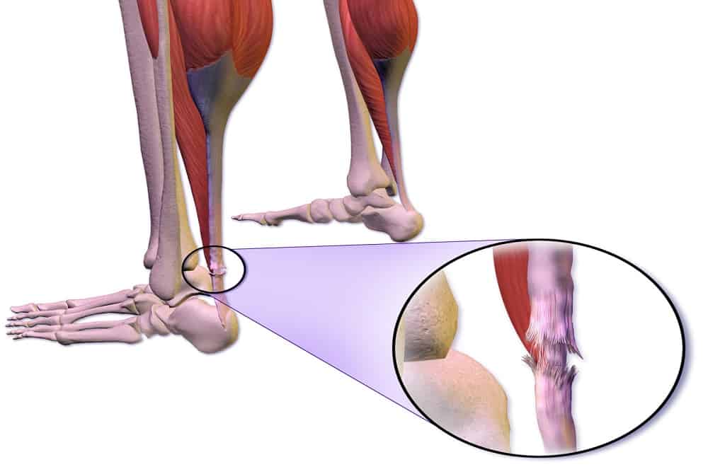 Achilles Tendon Rupture: अकिलिस टेंडन रप्चर क्या है? जानें इसके कारण, लक्षण और उपाय