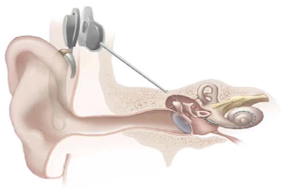 Auditory Brainstem Implant : एडिटर ब्रेनस्टेम इंप्लांट क्या है?