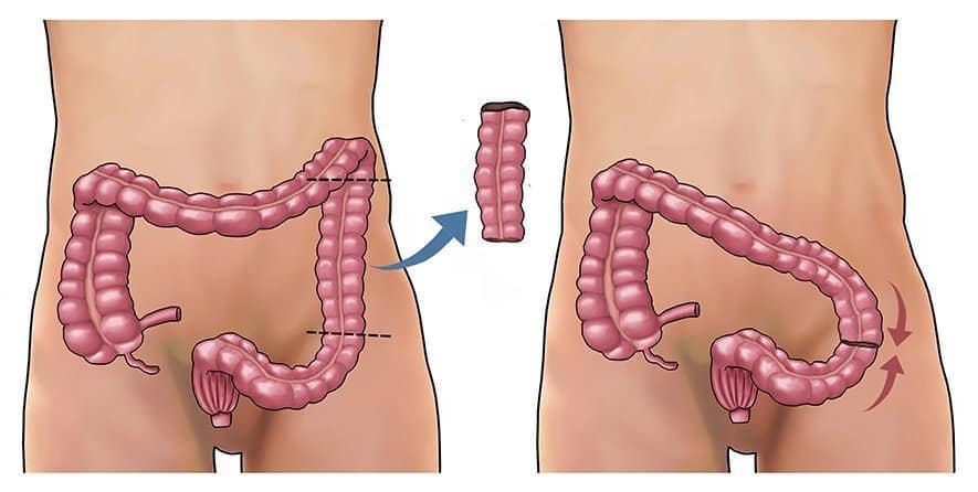 Colectomy Surgery: कोलेक्टमी सर्जरी क्या है?