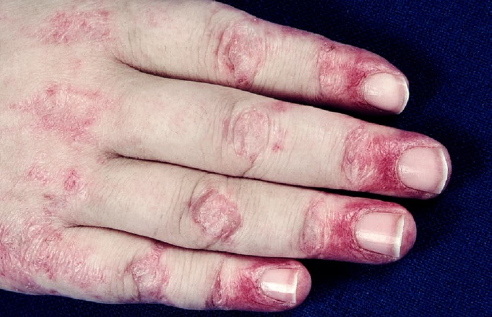 Dermatomyositis : डर्मेटोमायोसाइटिस क्या है?