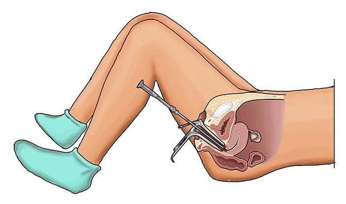 Dilation and Curettage : डाइलेशन और क्यूरेटेज क्या है?