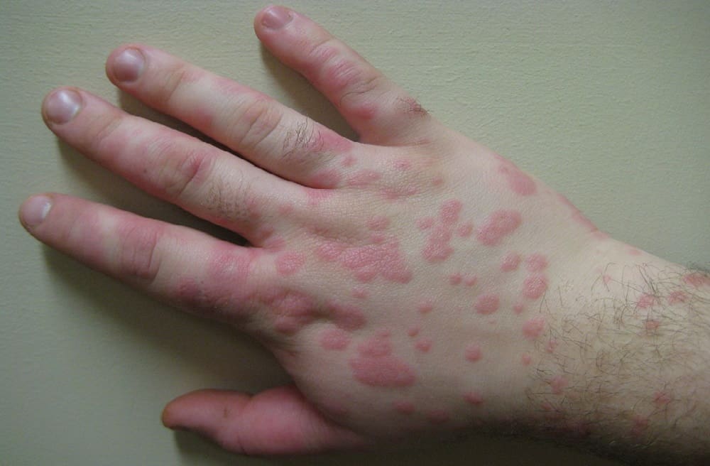 Erythema Multiforme : एरिथिमा मल्टीफॉर्म क्या है?