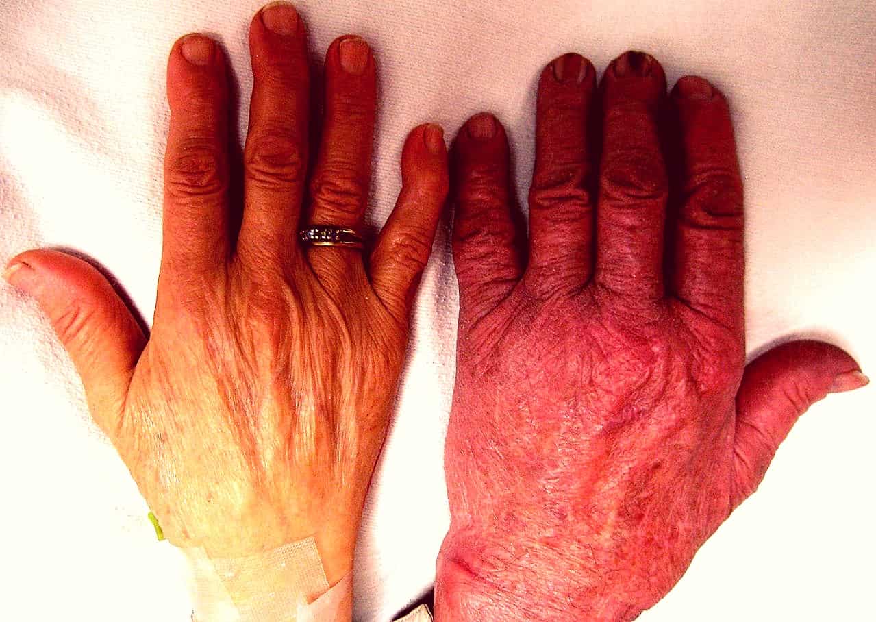 Fanconi Anemia : फैंकोनी एनीमिया क्या है? जानें इसके कारण, लक्षण और उपाय