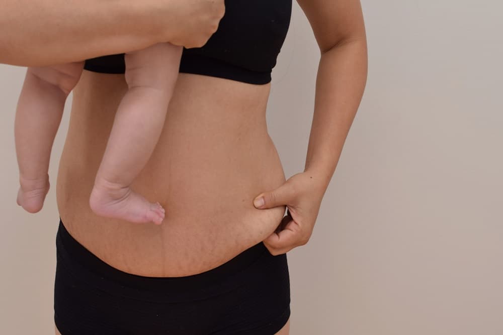 गर्भावस्था में स्ट्रेच मार्क्स: इन घरेलू उपचार से मिलेगा आराम