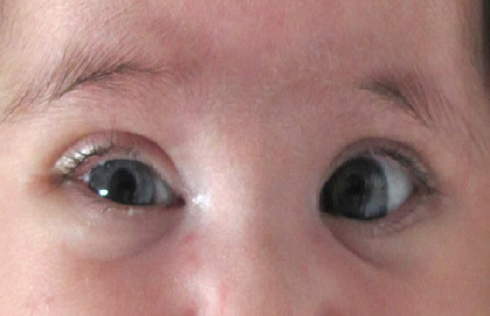 Horner syndrome : हॉर्नर सिंड्रोम क्या है?