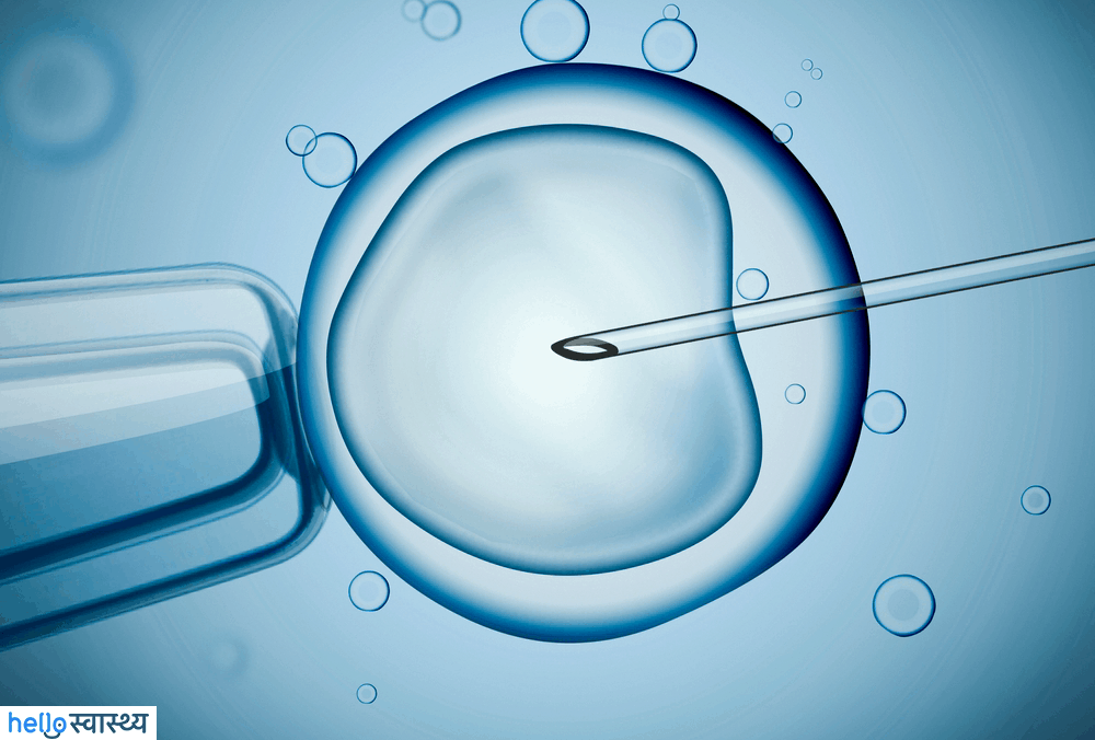 आईवीएफ (IVF) के साइड इफेक्ट्स: जान लें इनके बारे में भी