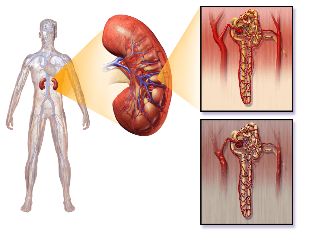 IgA nephropathy : आईजीए नेफ्रोपैथी (इम्युनोग्लोबुलिन ए) क्या है?