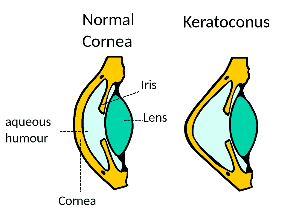 Keratoconus : केरेटोकोनस क्या है?