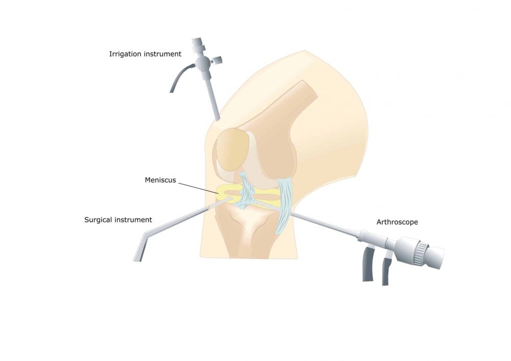 Knee Arthroscopy : घुटने की आर्थोस्कोपी सर्जरी क्या है?
