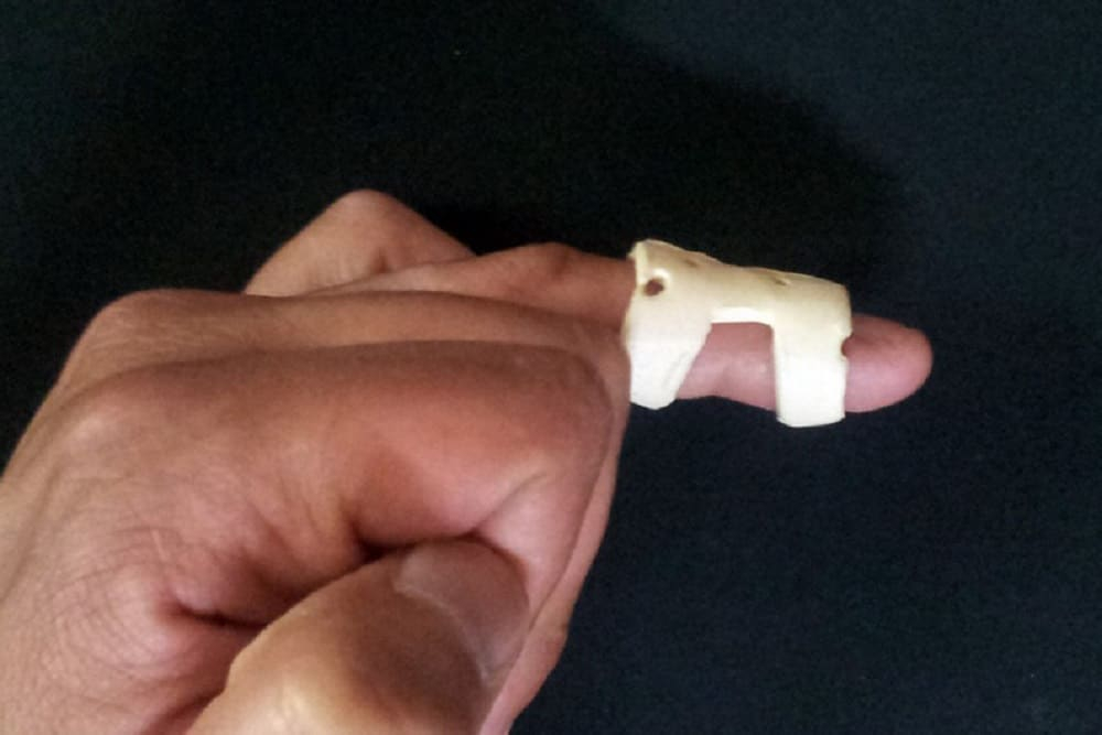 Mallet Finger: मैलेट फिंगर क्या है? जानें इसके कारण, लक्षण और उपाय
