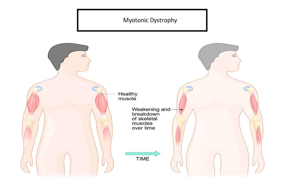 Myotonic Dystrophy : मायोटोनिक डिस्ट्रॉफी क्या है?