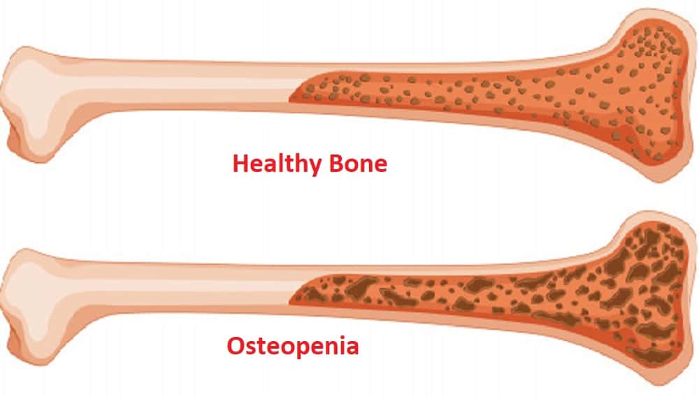 Osteopenia : ऑस्टियोपीनिया क्या है?