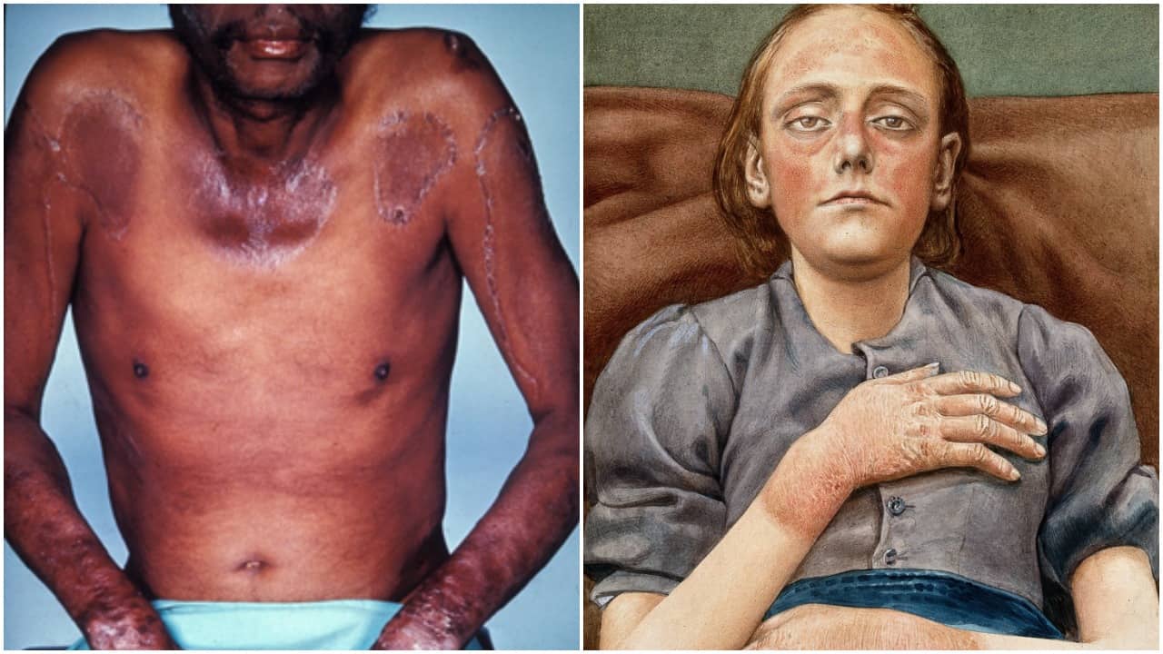 Pellagra : पेलाग्रा रोग क्या है?