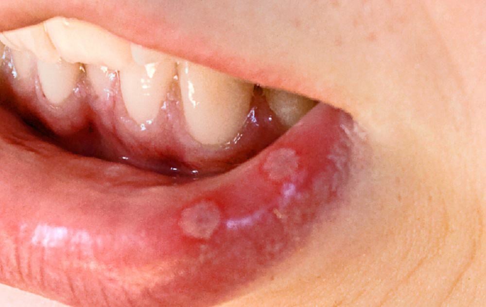 Stomatitis : स्टोमाटाइटिस क्या है?