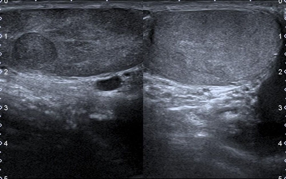 Testicular Ultrasound: टेस्टिकुलर अल्ट्रासाउंड क्या है?